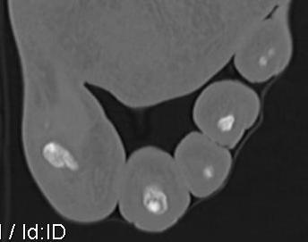 Osteoid Osteoma 2nd Toe CT